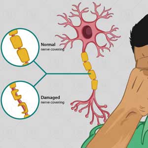 Multiple sclerosis treatment in Hyderabad